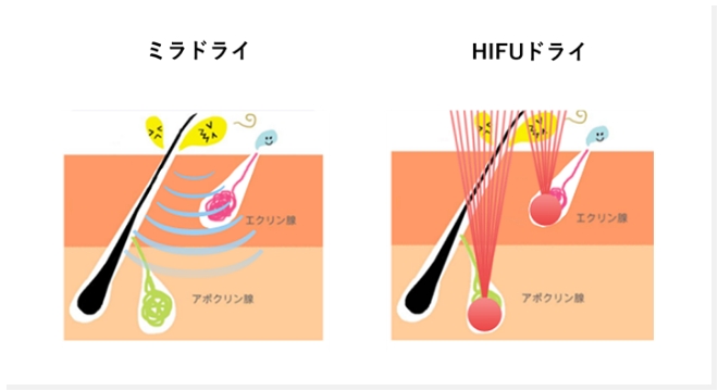 切らないワキガ・多汗症治療HIFUドライなら大阪梅田にある美容外科